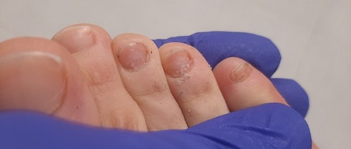 Figura 2. Paciente de 9 años. Onicomicosis. Mejoría de las lesiones blanquecinas y opacas, con persistencia de algunos restos en las placas ungueales del tercer, cuarto y quinto dedo del pie.