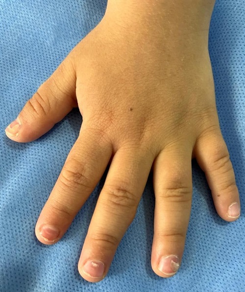 Figura 4. Desprendimiento proximal parcial de la lámina ungueal en primer y cuarto dedo de la mano izquierda, compatible con onicomadesis posterior a infección viral