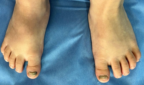 Figura 5. Onicomadesis en ambos hallux con presencia de melanoniquia y onicocauxis, observándose regeneración parcial de la lámina ungueal