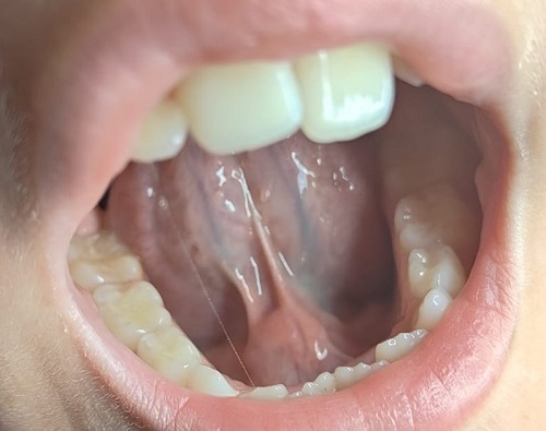 Figura 1. Tumoración submandibular a nivel de la salida del conducto de Wharton