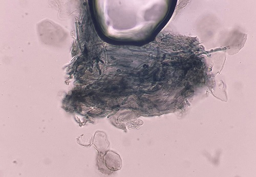 Figura 2. Examen micológico directo con KOH de muestra de borde de lesión glútea, donde se observan hifas fúngicas septadas, ramificadas y de paredes finas, compatibles con dermatofitos del género Trichophyton