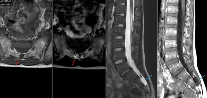 Figura 1. Síndrome de hipotensión intracraneal