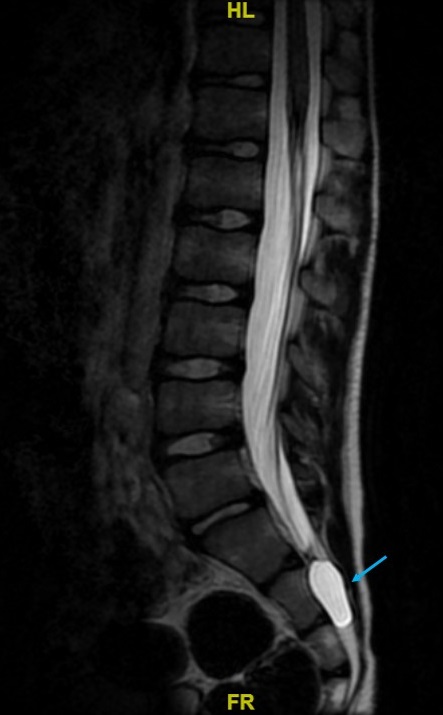 Figura 2. Síndrome de hipotensión intracraneal