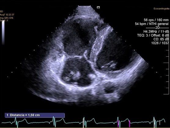 Figura 1. Ecocardiograma transtorácico realizado