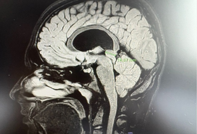 Figura 2. RMN con evidencia de aumento del quiste pineal.