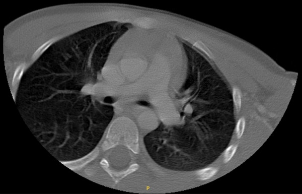 Figura 2. Tortícolis. Tomografía computarizada cervical (no absceso, alteración de la articulación entre la primera y la segunda vértebra cervical)