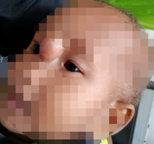 Figura 1. Encefalocele frontoetmoidal. Lactante de 8 meses con lesión facial a modo de masa interocular, redondeada y sobreelevada 