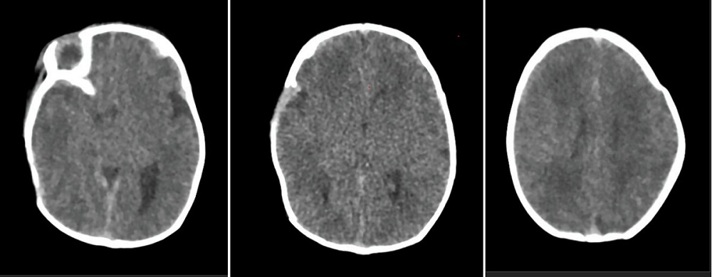 Figura 2. Caídas neonatales. TAC craneal: fractura longitudinal parietal izquierda con componente de cefalohematoma y dudoso hematoma epidural de 2 mm en convexidad superior en neonato de 48 horas de vida