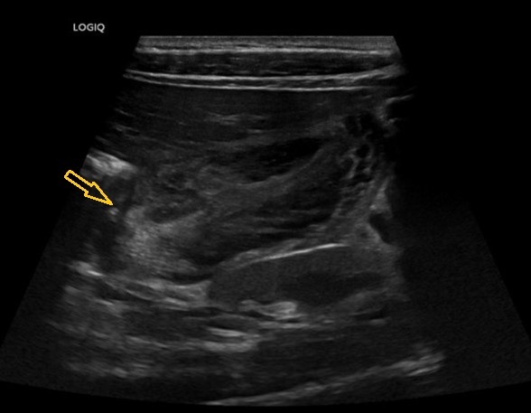 Figura 1. Edema vesicular. Vesícula de paredes engrosadas, en un paciente con infección por el virus de la hepatitis A