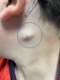 Figura 1. Pilomatrixoma cervical pediátrico
