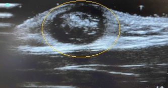 Figura 2. Pilomatrixoma cervical pediátrico
