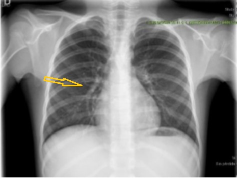 Figura 1. Tracto fibroso pulmonar. Radiografía de tórax postero-anterior donde se observa tracto fibroso pulmonar derecho