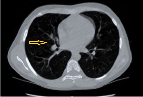 Figura 2. Tracto fibroso pulmonar. Corte axial TCAR, donde se observa una lesión fibroatelectásica localizada en el lóbulo medio, sin afectación difusa del parénquima pulmonar ni signos de enfisema