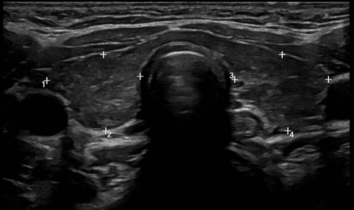 Figura 1. Tiroiditis autoinmune de Hashimoto. 