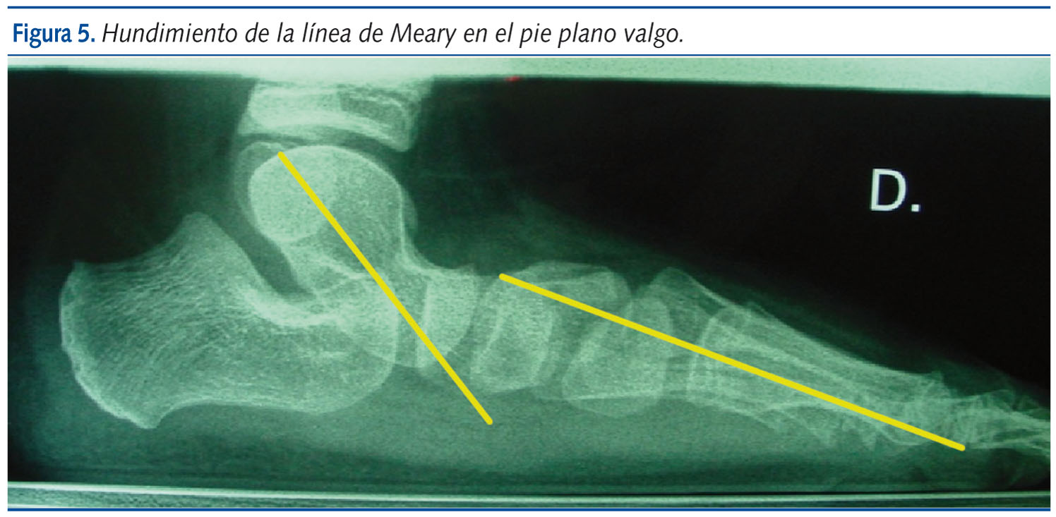Figura 5. Hundimiento de la línea de Meary en el pie plano valgo.