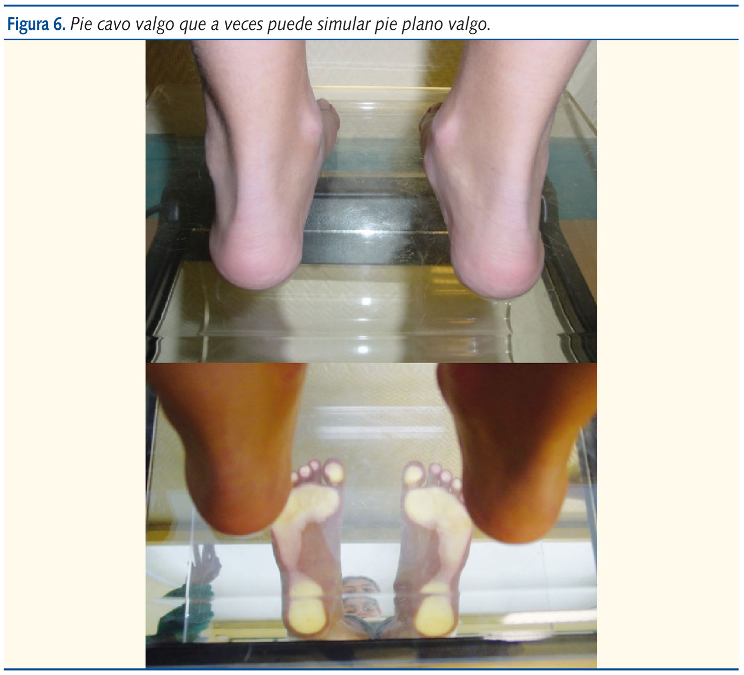 Figura 6. Pie cavo valgo que a veces puede simular pie plano valgo.