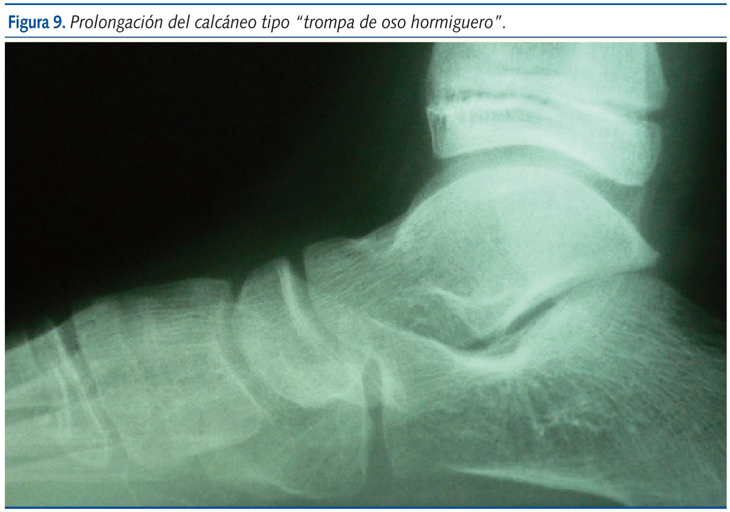 Figura 9. Prolongación del calcáneo tipo “trompa de oso hormiguero”.
