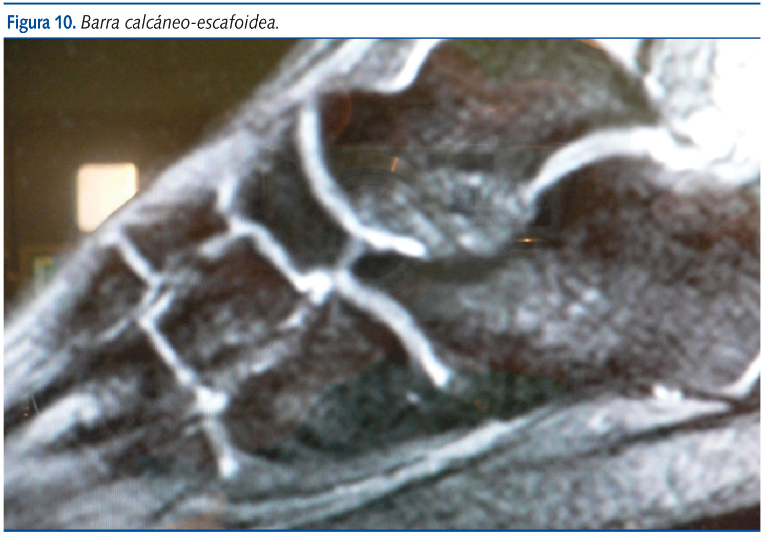 Figura 10. Barra calcáneo-escafoidea.