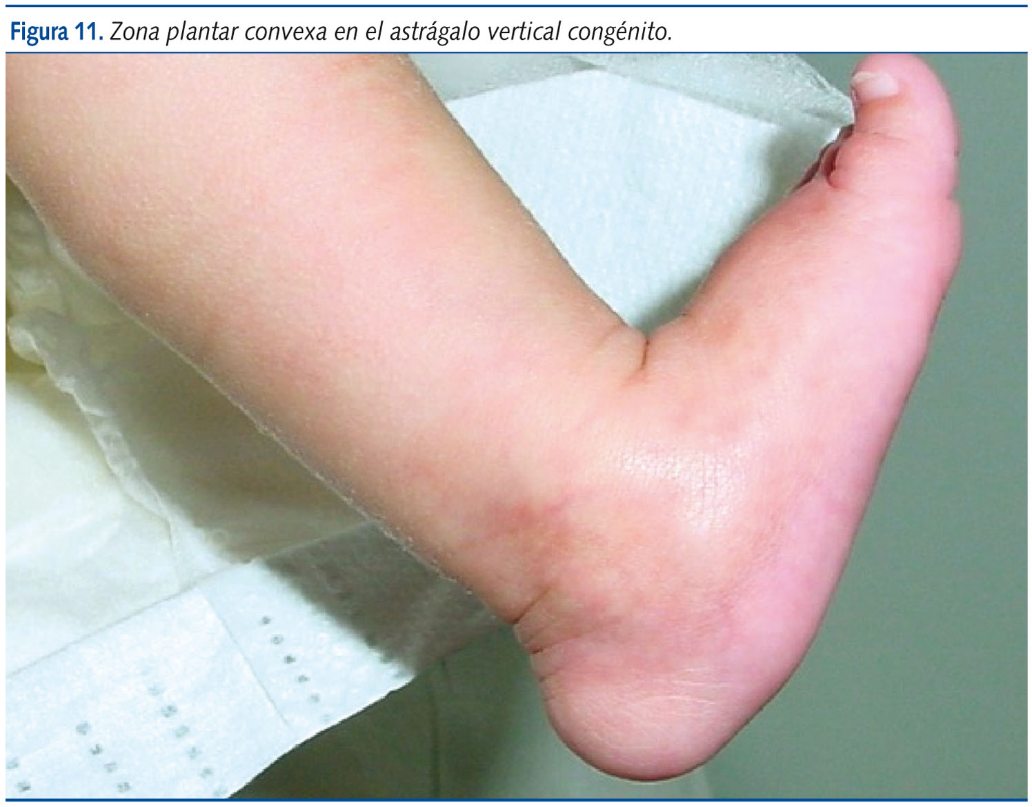 Figura 11. Zona plantar convexa en el astrágalo vertical congénito.