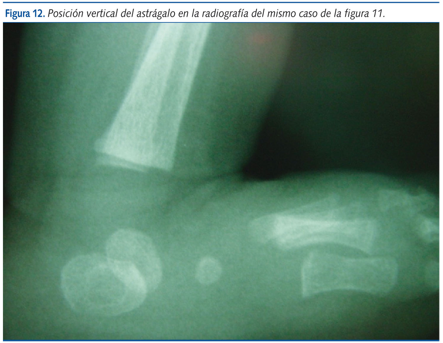 Figura 12. Posición vertical del astrágalo en la radiografía del mismo caso de la figura 11.