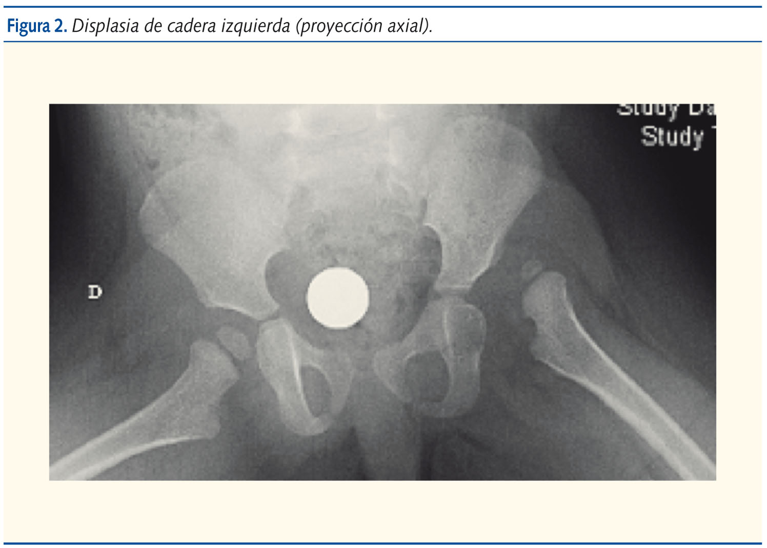 Figura 2. Displasia de cadera izquierda (proyección axial).