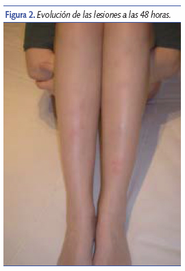 Evolución de las lesiones a las 48 horas