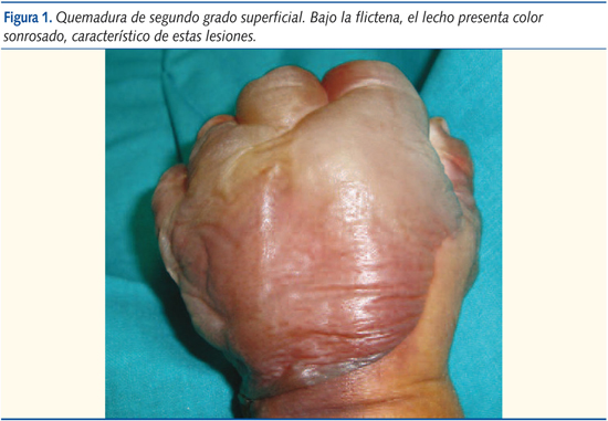Figura 1. Quemadura de segundo grado superficial. Bajo la flictena, el lecho presenta color sonrosado, característico de estas lesiones.