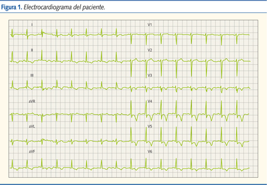Figura 1. Electrocardiograma del paciente.