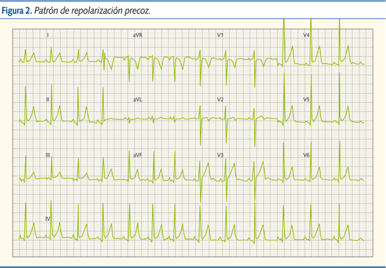 Figura 2. Patrón de repolarización precoz.